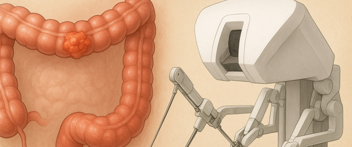 Operacje robotyczne raka jelita grubego w Oddziale Chirurgii Onkologicznej